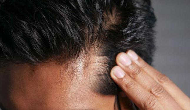 탈모 치료 및 억제제의 장점